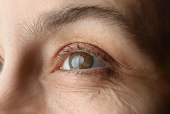 Open Angle Glaucoma symptoms