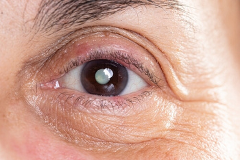 Can Cataracts Regrow again