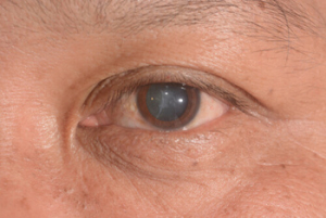 Glaucoma And Diabetes symptoms