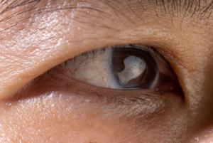 what does glaucoma do to your eyes results